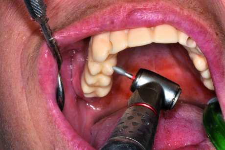 68. Funzionalizzazione del prototipo nel cavo orale della paziente.