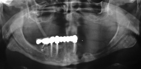 7. A distanza di 2 mesi si esegue una nuova ortopantomografia (OPT) di controllo che mostra una riattivazione dell’infezione in corrispondenza dell’osso mandibolare nel terzo quadrante.