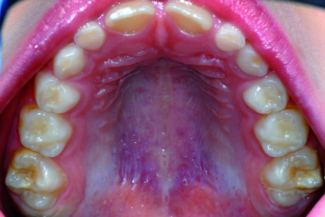 4. Ipomineralizzazione molare e incisiva sui primi molari superiori in bambina di 7 anni.