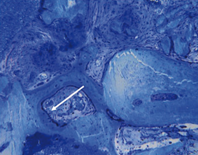 3. Colorazione con blu di toluidina per osteoblasti, osteociti e osso neoformato in un campione di FFB. L’osso neoformato (freccia bianca) appare colorato in maniera più intensa dell’osso nativo e di quello innestato.