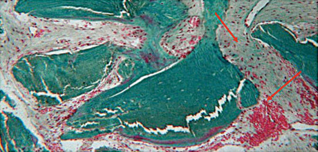 4. Colorazione tricromica di Gomori con evidenza di tessuto connettivo denso, aree erose e infiltrato infiammatorio in un campione di FFB (frecce rosse).