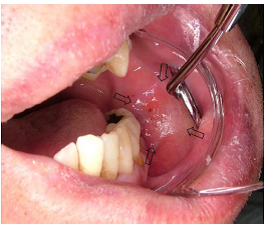 Fig. 1: l’esame intraorale rileva una certa tumefazione ossea a carico del ramo mandibolare senza alcuna anomalia della mucosa associata