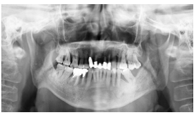 Fig 2: l’OPT rivela una zona di radiopacità ossea osteoblastica a carico del ramo ascendente mandibolare sx