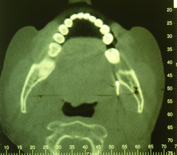 1-2. L’ortopantomografia e la tomografia computerizzata mostrano la posizione linguale della minivite ortodontica rispetto al ramo mandibolare.
