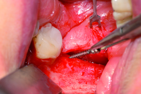 6. La minivite viene afferrata ed estratta attraverso una delicata trazione con l’ausilio di una pinza chirurgica.