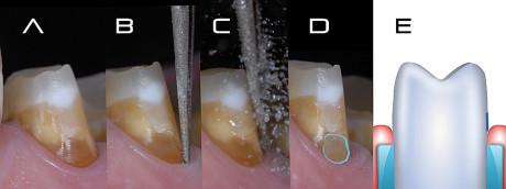 1. A: moncone prima della pulizia; B: posizionamento della punta sonica; C: punta sonica attivata con irrigazione; D: l’area del dente con dentina “riattivata”; E: schema in cui, in blu, viene rappresentata l’area dove ha lavorato la punta sonica.