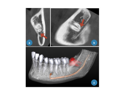 3. Terzo molare inferiore. Con la freccia (rossa) è indicata la stretta relazione tra radice del terzo molare e canale mandibolare: a) visione coronale; b) visione sagittale; c) rendering 3D degli elementi dentari, dell’emimandibola e del nervo alveolare inferiore (che permette una più comprensibile disposizione spaziale delle varie strutture di interesse).