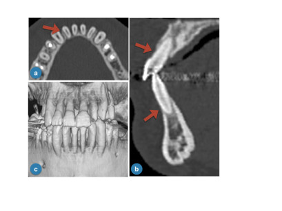 6. Stato parodontale: a) visione assiale che mette in evidenza l’assenza di osso sulla superficie vestibolare degli elementi frontali inferiori; b) visione sagittale che mostra (indicato dalla freccia) il livello del tessuto osseo vestibolare; c) rendering 3D della situazione parodontale del gruppo frontale. 