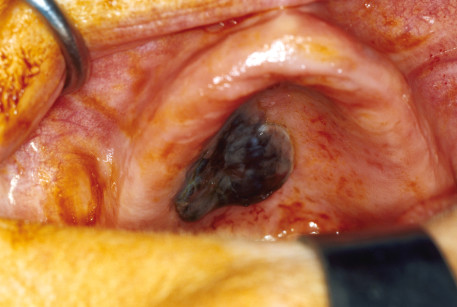2. Risultato al termine dell’exeresi della lesione. Si noti la mucosa delle cavità nasali visibile grazie all’asportazione del piano osseo del palato duro.