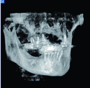 Figg. 3-4-5. Immagini radiografiche che evidenziano la presenza di una lesione radiotrasparente nella prima paziente.
