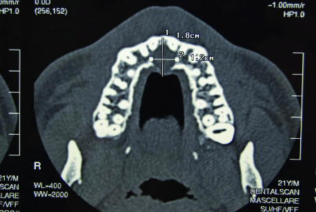 Figg. 6-7-8. Immagini radiografiche che evidenziano la presenza di una lesione radiotrasparente nel secondo paziente.