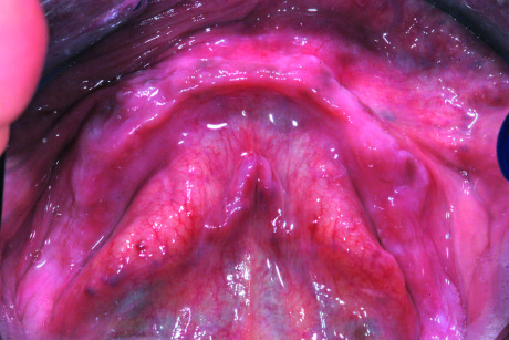 Fig. 2 - Vista occlusale pre-operatoria dei tessuti molli mandibolari. 