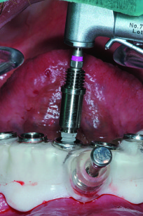 Fig. 3 - Inserimento implantare attraverso una dima per la chirurgia guidata.