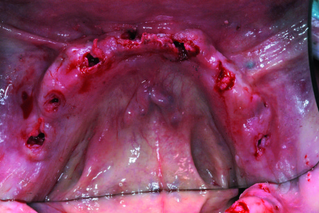 Fig. 4 - Vista occlusale dei tessuti molli mandibolari dopo l’inserimento degli impianti.