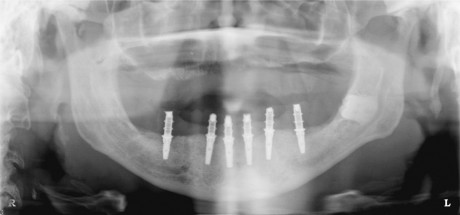 Fig. 11 - Ortopanoramica effettuata immediatamente dopo la chirurgia e l’inserimento della protesi avvitata.