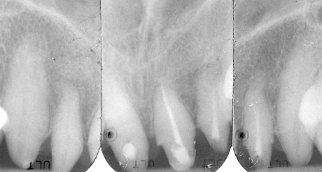 8. Le radiografie pre-operatorie evidenziano un mantenuto livello di attacco parodontale.