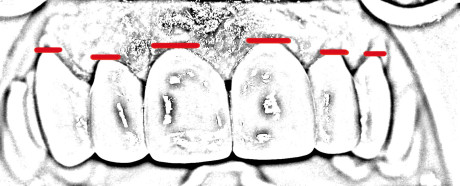 15. Rappresentazione grafica delle nuove forme dentali e del nuovo andamento gengivale: buon ripristino delle simmetrie gengivali e dentali.