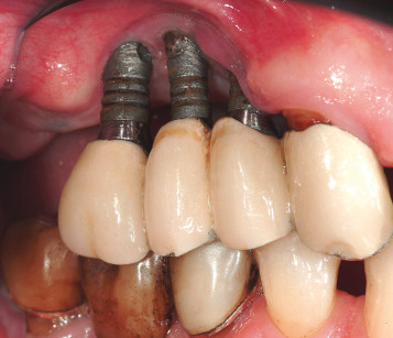 1. Impianti dentali falliti.