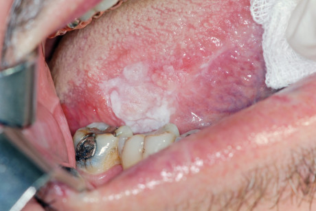 1. Immagine clinica di lesione leucoplasica presente da circa 1 anno, sul bordo linguale destro, in paziente forte fumatore. 