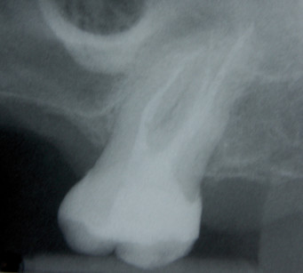 8. Radiografia endorale finale di controllo. Si noti il minimo sacrificio di tessuto dentale intracanalare sano.