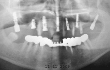 3. Ortopantomografia eseguita subito dopo il posizionamento degli impianti al posto degli elementi dentari ridotti (vedi figura 2).