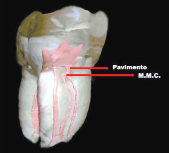 1. Immagine di un primo molare inferiore dove tra il pavimento della camera pulpare e l’orifizio del canale mesiale mediano è presente circa 1 mm di dentina.