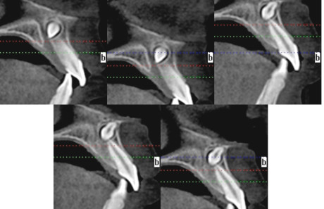 Fig. 15 - Sezioni sagittali di immagini TC con Denta Scan. La posizione del mesiodens suggerisce un approccio chirurgico vestibolare.