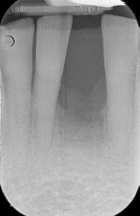 3. Caso clinico iniziale: radiografia intraorale.