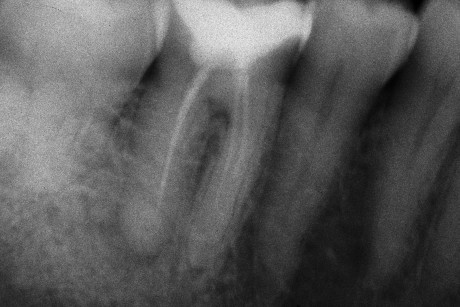 1. Radiografia periapicale pre-operatoria.  Primo molare inferiore destro con terapia endodontica incongrua e radiotrasparenza periapicale della radice distale.  Il piano di cura endodontico prevede il ritrattamento del sistema  dei canali radicolari.