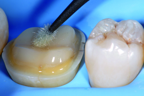 13. Applicazione del bonding sui tre substrati della preparazione: smalto, dentina e composito del build-up. Precedentemente è stato applicato il primer sulla dentina.