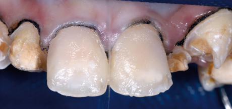 9. Applicazione di Esthet-X HD (A1). Build-up della dentina e dei mamelloni.