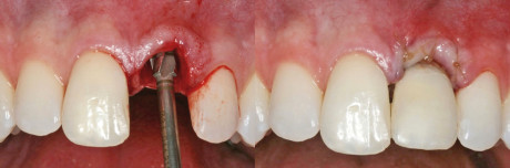 5. Posizionamento implantare immediato e funzionalizzazione immediata con corona provvisoria, sfruttando i resti del dente estratto. 