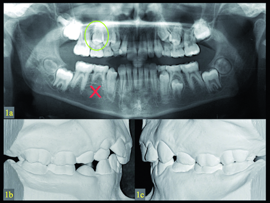 1. a) Radiografia panoramica di un paziente di 12 anni e 4 mesi con agenesia del secondo premolare di destra inferiore (croce rossa) e affollamento nel mascellare. Il secondo premolare superiore di destra in sviluppo (cerchio verde) è stato destinato a sostituire il dente permanente mancante nella mandibola, in accordo con le indicazioni ortodontiche. b,c) I modelli diagnostici prima della chirurgia mostrano una malocclusione di II Classe, divisione 2 e affollamento nel mascellare.