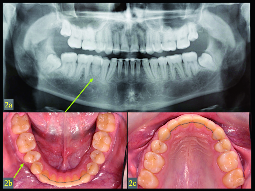 2. a) Radiografia panoramica del paziente dopo sette anni dall’autotrapianto del secondo premolare superiore di destra nel sito di agenesia del secondo premolare inferiore (freccia verde). b,c) Immagine occlusale delle arcate dentali prima del trattamento ortodontico (la freccia verde indica il dente trapiantato). Una normale ampiezza dell’alveolo e una banda di tessuto sano cheratinizzati circondano il trapianto. 