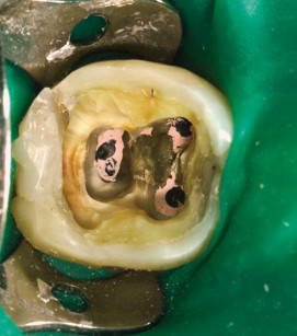 4. Rimozione del tessuto carioso e ritrattamento endodontico dell’elemento 46.