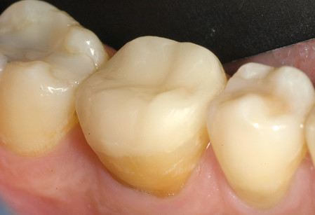 11. Si noti l’armonia dell’overlay con gli elementi dentali adiacenti.