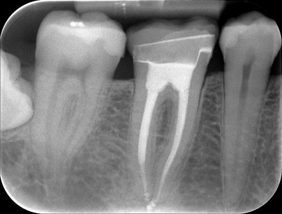 12. Immagine radiografica del restauro cementato; si noti il cemento che sigilla l’interfaccia intarsio-dente. 