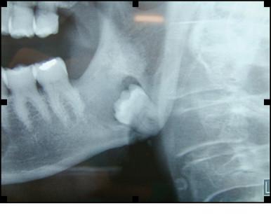 1. Rx ortopantomografia pre-operatoria dove si osserva l’elemento 3.8 in inclusione ossea.