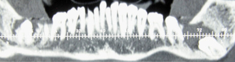 3. TC dental-scan pre-operatoria.