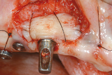 13. Lembo bilaminare: innesto di connettivo posizionato a copertura del colletto implantare esposto.