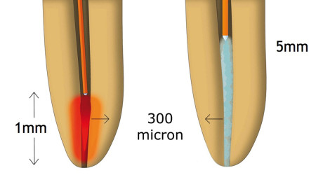 4. Differenti applicazioni di punte endodontiche tradizionali per laser a erbio e nuove punte PIPS.