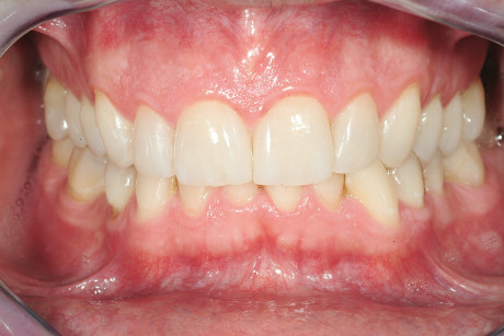 3. Immagine intraorale dei restauri finali dopo un anno di follow-up. Tutti i denti hanno mantenuto la loro vitalità. 