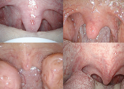 1. Immagini endoscopiche: pendente palato molle, sovradimensionato, uvula allungata, tonsille palatine ipertrofizzate.  
