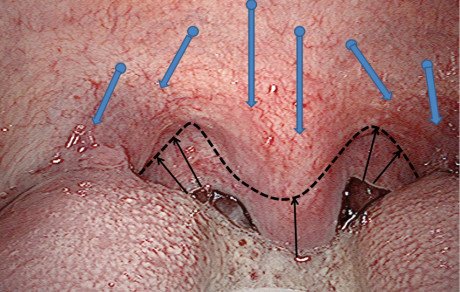 2. Immagine del palato molle prima della chirurgia con tecnica UPP RFITT. 