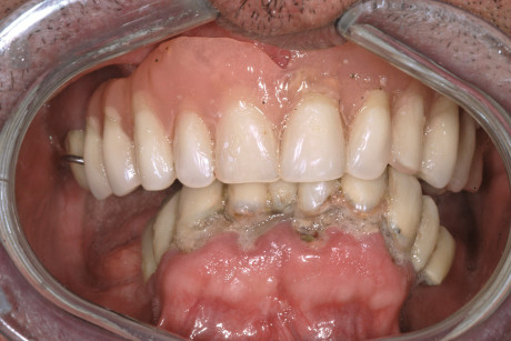 1. Il caso clinico prima del trattamento. Notare la perdita completa dei normali rapporti occlusali e la pessima igiene orale.