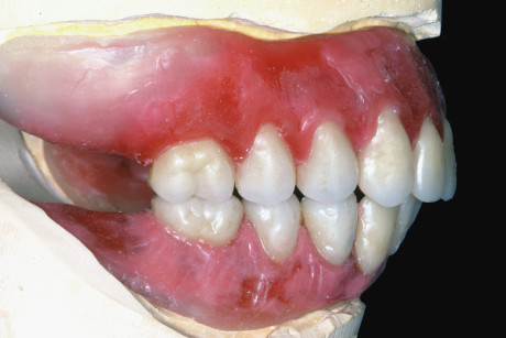 2. I denti montati sulle protesi totali evidenziano un rapporto di IIa classe.2. I denti montati sulle protesi totali evidenziano un rapporto di IIa classe.