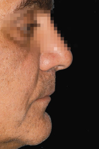 7. Il profilo testimonia il corretto sostegno del filtro del labbro, del vermiglio e un solco labio-mentoniero poco accentuato.