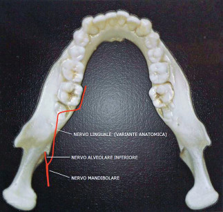 2. Variante anatomica del decorso del nervo linguale.
