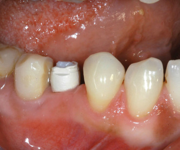 6. Guarigione a 5 mesi: visione intra-orale.