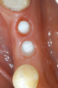 7. Guarigione a 8 mesi: visione intra-orale occlusale.